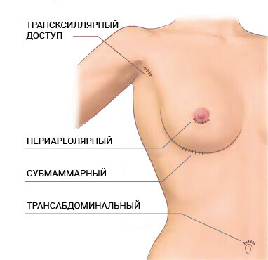 выбор доступа для импланта
