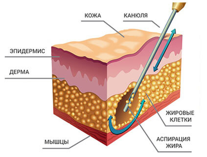 о липосакции коленей