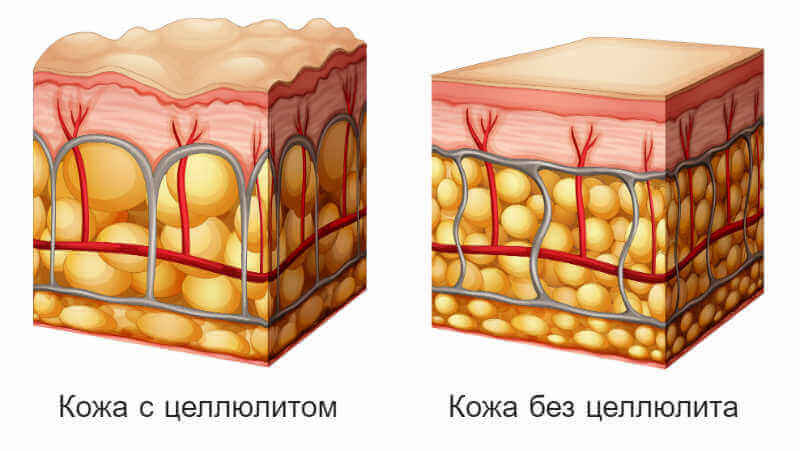 Целлюлит