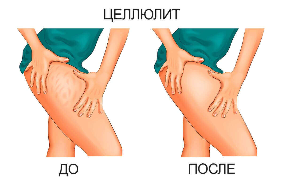 массаж антицеллюлитный