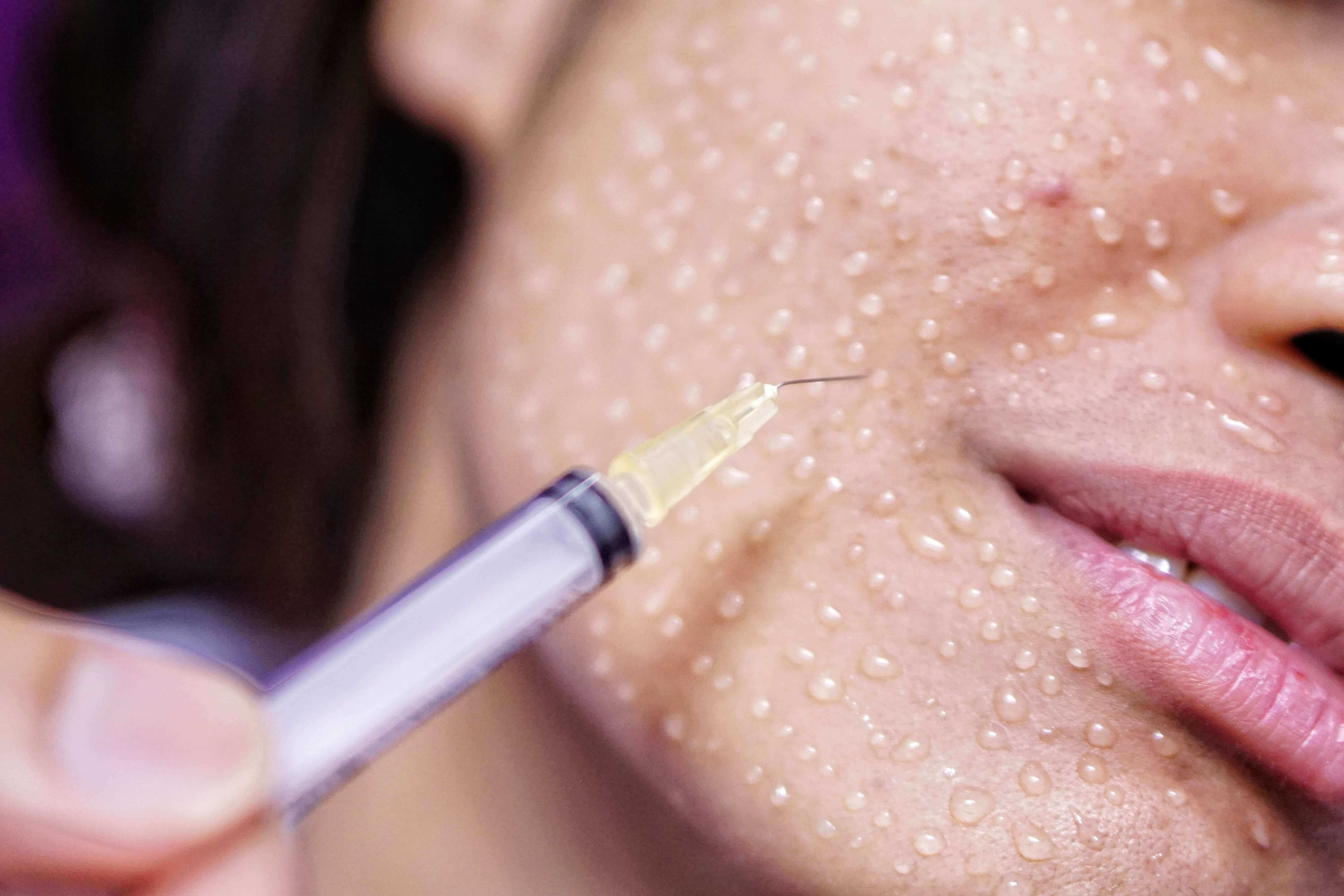 техника проведения мезотерапии