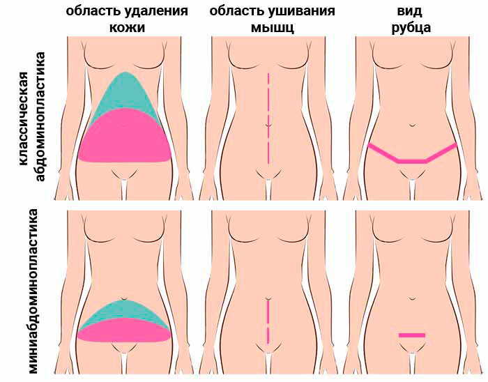 абдоминопластика процесс