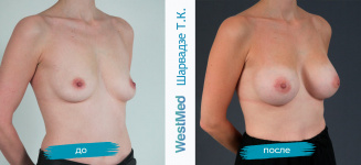 Фото до и после маммопластики