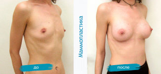 Маммопластика: фото до и после